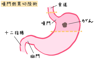 噴門胃切除術の画像