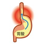 胃酸の逆流イラスト画像