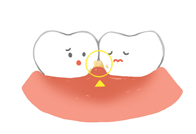歯周病のイラスト画像
