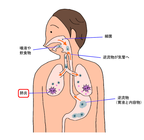 胸焼け 肺炎 「痰が絡む」のは体からの危険信号？痰が絡む原因や考えられる病気、そして上手な痰の出し方