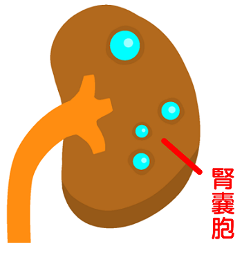 腎臓　嚢胞
